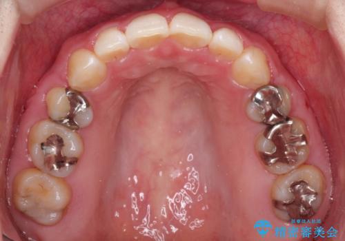 口が閉じずらく、口元出てるのが気になる ワイヤー抜歯矯正による口元の改善の治療後