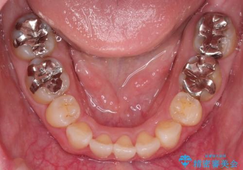 口が閉じずらく、口元出てるのが気になる ワイヤー抜歯矯正による口元の改善の治療後