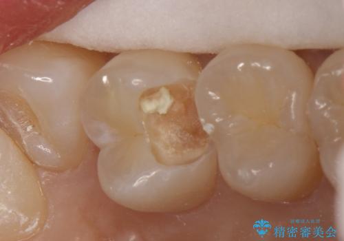 気づかないうちに大きな虫歯が 神経を保存し、セラミックで修復の治療中