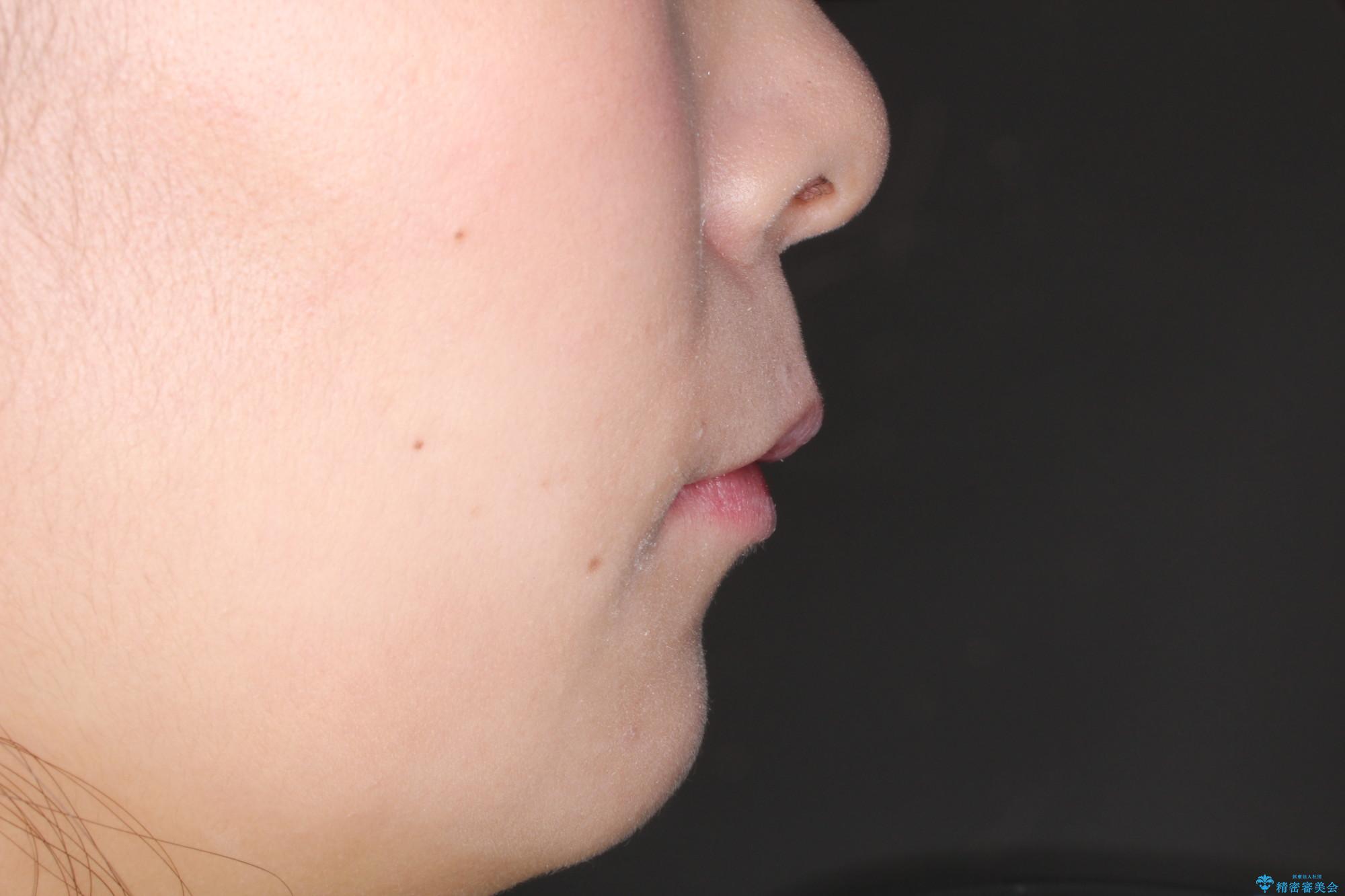 口が閉じずらく、口元出てるのが気になる ワイヤー抜歯矯正による口元の改善の治療後(顔貌)