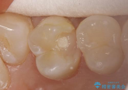 気づかないうちに大きな虫歯が 神経を保存し、セラミックで修復の治療中