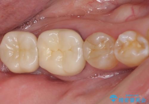 部分矯正を併用した、ストローマンインプラントによる奥歯の咬合回復の症例 治療後