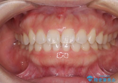 前歯のデコボコを治したい インビザラインによる矯正治療
