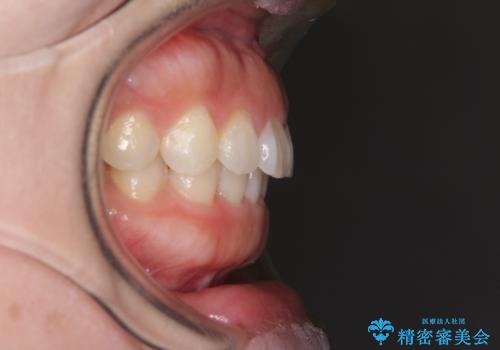 前歯のデコボコを治したい　インビザラインによる矯正治療の治療後