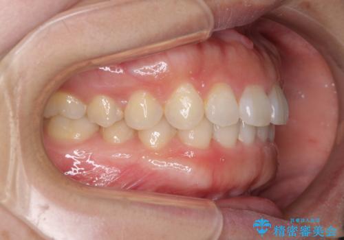 前歯のデコボコを治したい　インビザラインによる矯正治療の治療後