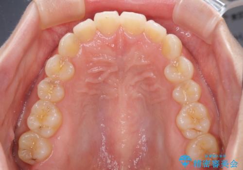 前歯のデコボコを治したい インビザラインによる矯正治療の治療後