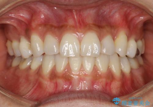 ハーフリンガル抜歯矯正　八重歯を改善するの治療後