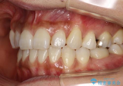 ハーフリンガル抜歯矯正　八重歯を改善するの症例 治療後