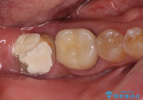 部分矯正を併用した、ストローマンインプラントによる奥歯の咬合回復の症例 治療前