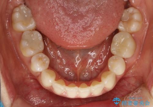 ハーフリンガル抜歯矯正　八重歯を改善するの治療後
