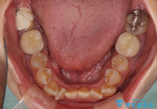 部分矯正を併用した、ストローマンインプラントによる奥歯の咬合回復の治療前