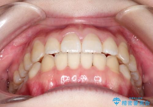 前歯がガタガタ・噛み切りにくい インビザラインによる歯を抜かない矯正の治療後
