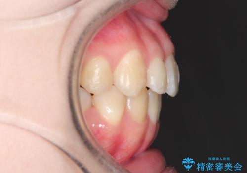 前歯がガタガタ・噛み切りにくい インビザラインによる歯を抜かない矯正の治療後