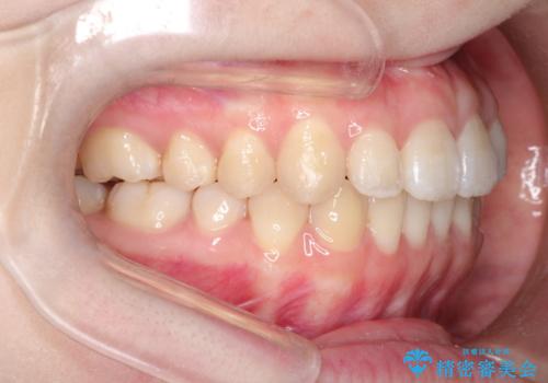 前歯がガタガタ・噛み切りにくい　インビザラインによる歯を抜かない矯正の治療後
