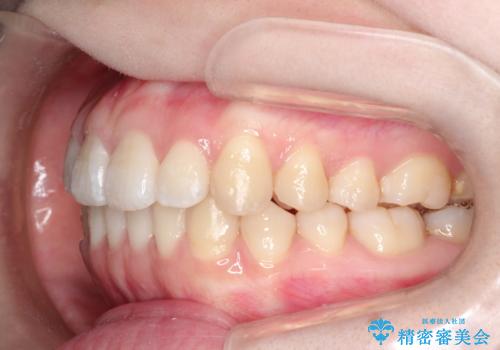前歯がガタガタ・噛み切りにくい インビザラインによる歯を抜かない矯正の治療後