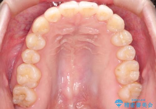 前歯がガタガタ・噛み切りにくい インビザラインによる歯を抜かない矯正の治療後
