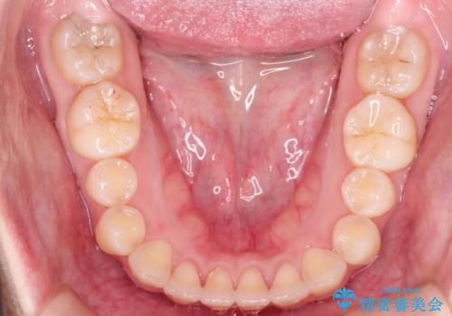 前歯がガタガタ・噛み切りにくい　インビザラインによる歯を抜かない矯正の治療後