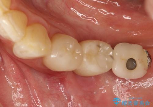 奥歯がない　インプラント治療でかみあわせを回復の症例 治療後