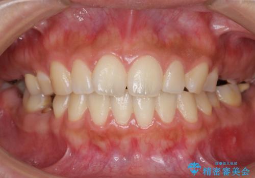 自家歯牙移植 使っていない親知らずを移植 20代女性の治療前