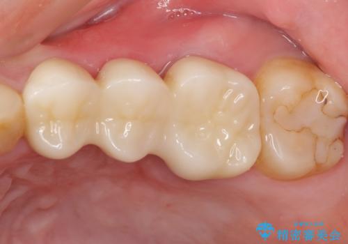 異臭のする歯を抜歯 奥歯のセラミックブリッジ治療の治療後