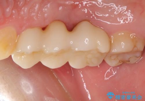 異臭のする歯を抜歯 奥歯のセラミックブリッジ治療の治療後