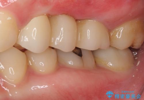 異臭のする歯を抜歯 奥歯のセラミックブリッジ治療の治療後