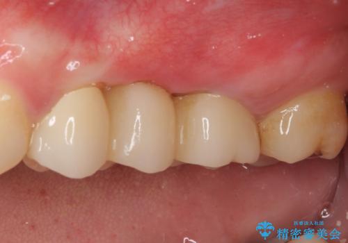 異臭のする歯を抜歯　奥歯のセラミックブリッジ治療