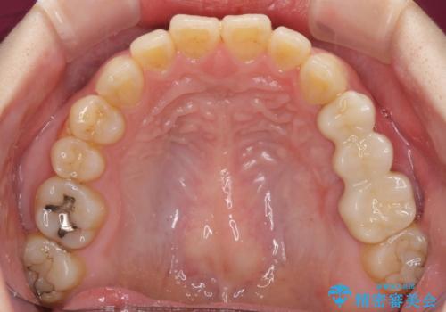 異臭のする歯を抜歯　奥歯のセラミックブリッジ治療の治療後