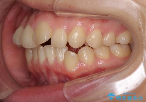 デコボコで飛び出した前歯をきれいに　インビザラインによる矯正治療の治療前