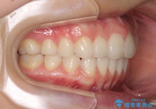デコボコで飛び出した前歯をきれいに　インビザラインによる矯正治療の治療後