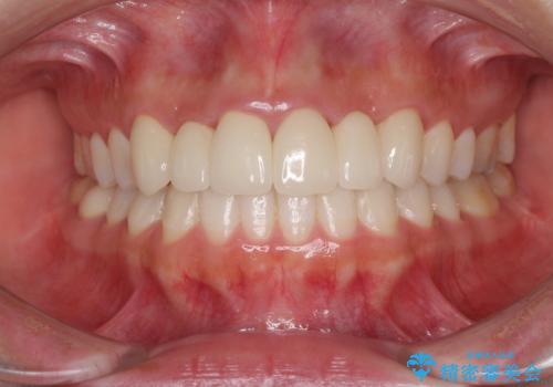 気になる前歯を審美歯科治療と矯正歯科治療で美しくの症例 治療後