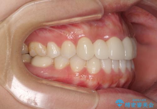 気になる前歯を審美歯科治療と矯正歯科治療で美しくの治療後