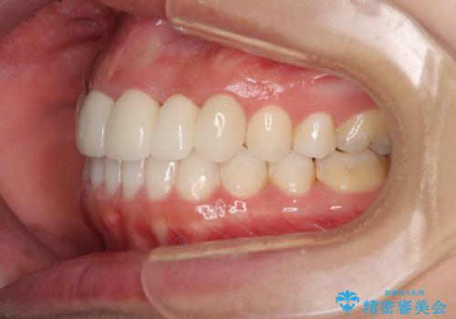 気になる前歯を審美歯科治療と矯正歯科治療で美しくの治療後