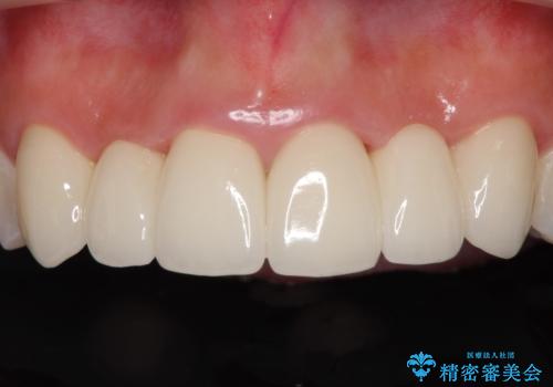 気になる前歯を審美歯科治療と矯正歯科治療で美しくの治療後
