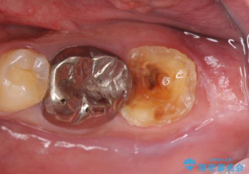 歯冠長延長術を併用した審美的歯科治療の症例 治療前