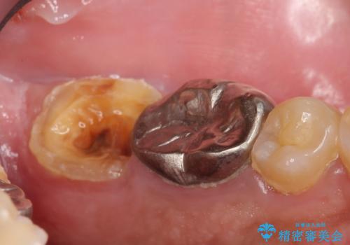 歯冠長延長術を併用した審美的歯科治療の治療前