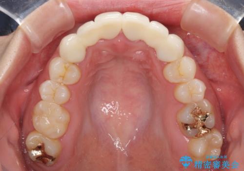 気になる前歯を審美歯科治療と矯正歯科治療で美しくの治療後