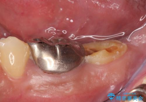 歯冠長延長術を併用した審美的歯科治療の治療前