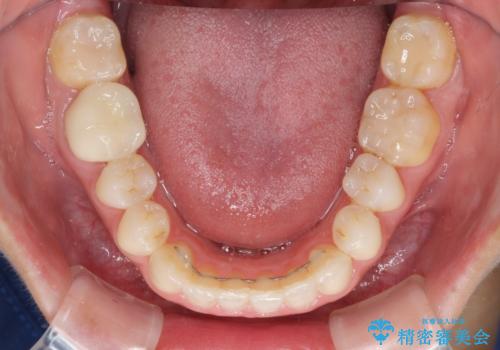 気になる前歯を審美歯科治療と矯正歯科治療で美しくの治療後