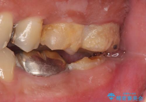 歯冠長延長術を併用した審美的歯科治療の治療前