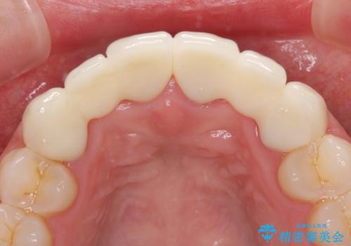 気になる前歯を審美歯科治療と矯正歯科治療で美しくの治療後