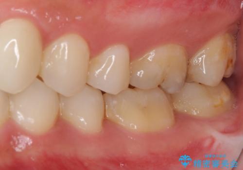 気になる前歯を審美歯科治療と矯正歯科治療で美しくの治療後