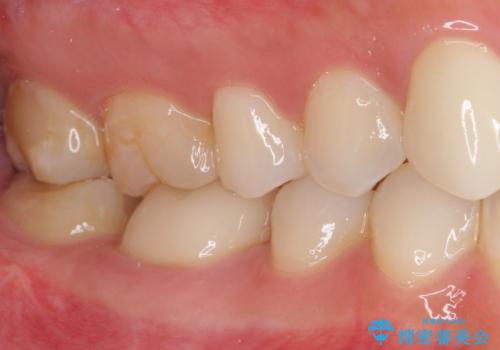 気になる前歯を審美歯科治療と矯正歯科治療で美しくの治療後