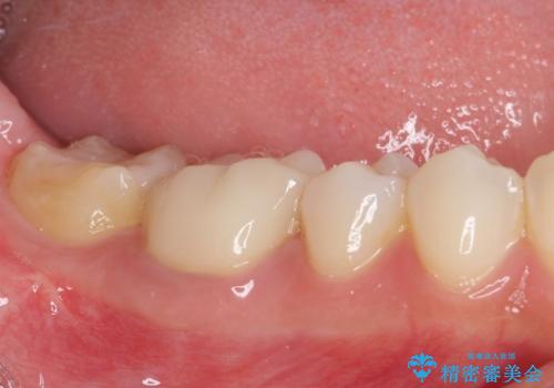 気になる前歯を審美歯科治療と矯正歯科治療で美しくの治療後