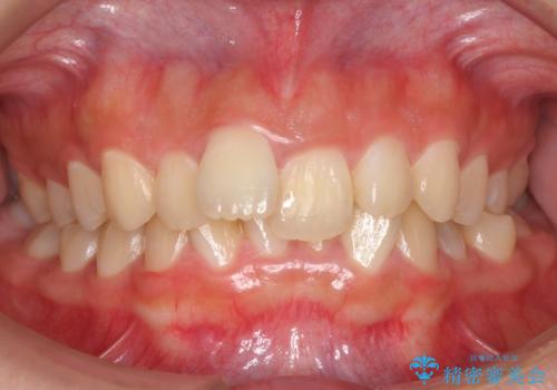 出っ歯をセラミックで治したい