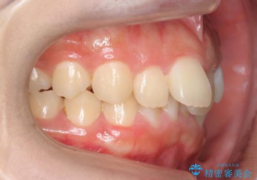 出っ歯をセラミックで治したい の治療前