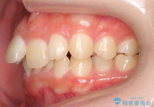 出っ歯をセラミックで治したい の治療前