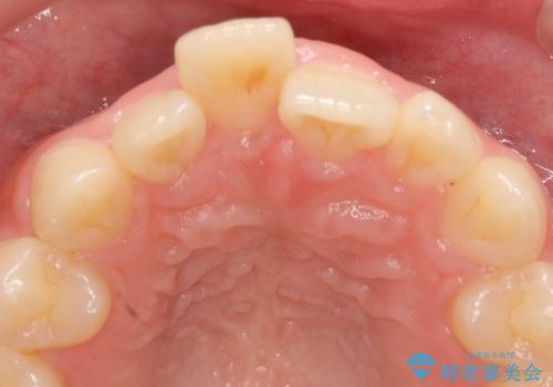 出っ歯をセラミックで治したい の治療前