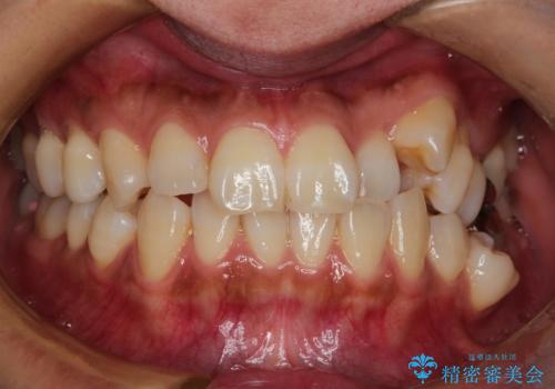 ハーフリンガル抜歯矯正　八重歯を改善するの治療前
