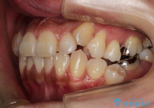 ハーフリンガル抜歯矯正　八重歯を改善するの症例 治療前